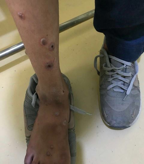 First positive case of monkeypox registered in Afghanistan