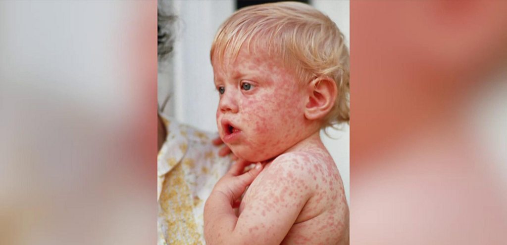 70 children die of measles in Badakhshan